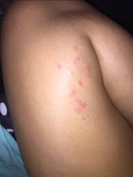 Itchy Rash On Inner Thighs Glow Community