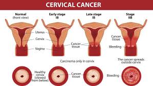 Cancer of the cervix often has no symptoms in its early stages. Hpv And Flu Vaccines Who Needs Them What Are The Risks If You Don T Get Them
