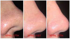 Using your fingers or a cotton pad, apply the exfoliant to your face and neck. How To Get Clear Skin Paula S Choice 2 Bha Fix My Acne Blackheads And Dark Spots