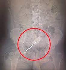Screwdriver Inside Man S Anus Caused Him Life Threatening Septic Shock