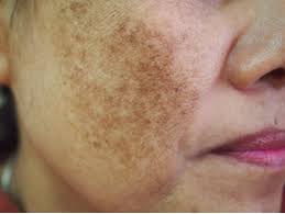 Image result for Melasma