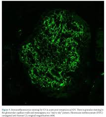 In psgn, involvement of derivatives of streptococcal proteins has been reported. Edgar V Lerma On Twitter Postinfectious Glomerulonephritis Nephpearls Langoteamit Gag Aggarwal Tukaramj Mayuritrivedi80 Arvindcanchi Https T Co Kdu5u8xwzd Https T Co Pb3ecf5jyx