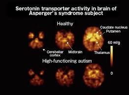 Helping different kinds of minds succeed. Asperger S Brain Scan Vs Normal Brain Google Search Brain Scan Aspergers Syndrome Aspergers