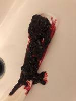 Wie war es denn bei euch?hat das auch so lange gedauert?hab ein test gemacht.ist negativ.dieses lange warten nervt. Achtung Bild 4 Tage Nach Ausschabung Starkes Blut Mit Gewebe Urbia De
