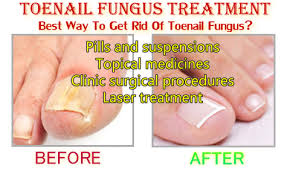 Find Our What Are The Most Effective Toenail Fungus Treatment Home Treatments Risks And Ways To Prev Toenail Fungus Treatment Fungus Treatment Toenail Fungus