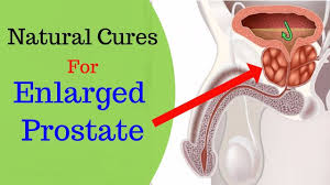6 Effective Home Remedies To Treat Prostate Enlargement Youtube Enlarged Prostate Prostate Health Prostate