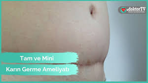 Karin Germe Ameliyati Abdominoplasti Mini Karin Germe Tam Karin Germe Doc Dr Erdem Guven Youtube