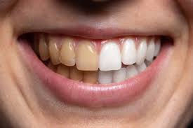 Harga putihkan gigi di klinik kerajaan mungkin berbeza dan lebih murah jika dibandingkan dengan di klinik swasta. Ø²ÙˆÙ„ÙØ¶Ù„ÙŠ Ø²ÙŠÙ† On Twitter Pagi Ni Nak Sharing Pasal Teeth Whitening Atau Putihkan Gigi Di Klinik Berdaftar Aku Tahu Ramai Betul Berminat Dan Teringin Nak Buat Whitening Ni Aku Share Sedikit Benda