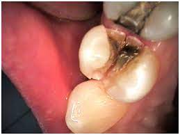 Broken Tooth Becomes A Smile Makeover Cary Family Dental Dr Allan Acton