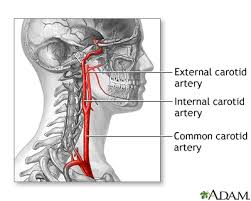 Cervical artery dissection is a dissection of any of the arteries in the neck. Carotid Artery Surgery Series Normal Anatomy Medlineplus Medical Encyclopedia