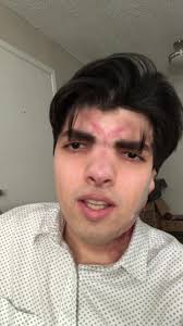 The Struggle to Control My Eye: A Journey of Overcoming Challenges