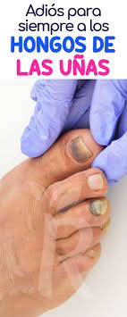 Hongos En Las Uñas De Las Manos Como Eliminarlos Como Eliminar Los Hongos De Las Unas De Los Pies Rapidamente Con Remedios Caseros Pie De Atleta Hongos Unas Onicomicosis Hon Feet Care Helpful Hints Health