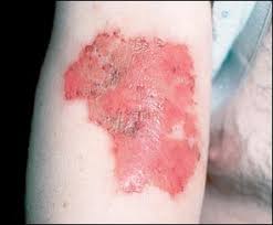 Image result for Neurotic Excoriation