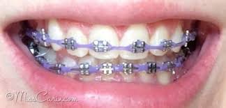 Black And Purple Braces Color Violet Cute Braces Braces Teeth Colors Braces Colors