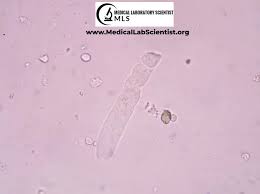 Image result for Urinary Cast