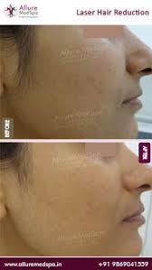 Laser hair removal is an effective treatment for unwanted hair for both men and women. Permanent Laser Hair Removal Treatment Cost At Andheri West Mumbai India