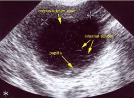 Image result for corpus luteum sonography)