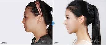 Aquiline Nose Surgery Nose Shape Surgery In Korea Plastic Surgery Facial Surgery Nose Surgery