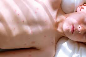 Image result for shingles in children
