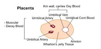 Image result for Delayed Transition from Fetal Circulation