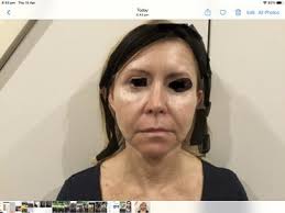 Facial Fat Transfer Sydney