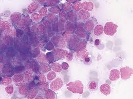 What are blood and bone marrow cancers. Image Gallery