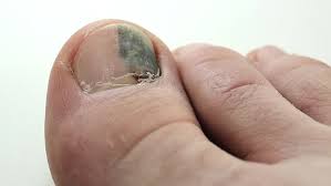 Imajte na umu da nedostatak vitamina d, b1, kalcijuma može dovesti do promena na noktima Krv Ispod Noktiju Lijecenja Palca Kako Lijeciti Modrice Pod Noktima Velikih Prstiju