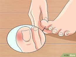 Einen Entzundeten Zeh Heilen Wikihow