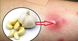 Gunakan beberapa batang lidah buaya tua, ambil bagian gelnya, oleskan secara merata pada bisul. Kenapa Bisul Kerap Timbul Apakah Bahaya Bisul Pada Kawasan Vagina