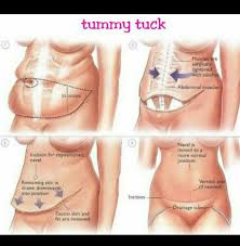 Pin By Lori Pappan On Mommy Makeover Mommy Makeover Surgery Body Contouring Surgery Tummy Tuck Surgery