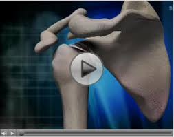 Shoulder Replacement Surgery Pro Sports Orthopedics