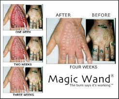Tattoo Removal Surgery Melbourne At Home Tattoo Removal Tattoos For Kids Tattoo Removal Cost