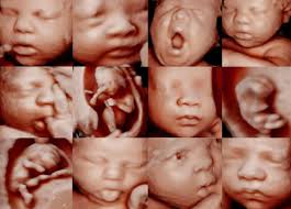 3D/4D ultrasounds and early gender determination in Southern California