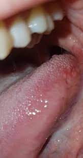 Inhaltsverzeichnis anzeigen symptome von pickel auf der zunge. Weiss Jemand Was Das Fur Pickel Auf Der Zunge Sind Mund