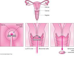 It also tells if the cancer has spread to nearby organs or places farther. Large Loop Excision Of The Transformation Zone Lletz