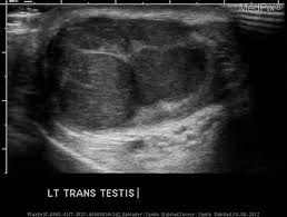 The initial evaluation of a possible testis cancer should involve: Medpix Case Seminoma