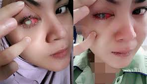Budhe titiek adalah pensiunan pns. Sedapkan Gosok Mata Sebelum Teruskan Kena Tahu Apa Risikonya Boleh Ke Letak Eye Drop Pada Mata Remaja