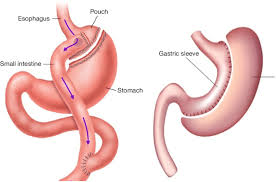Choosing between gastric sleeve or gastric bypass is a huge decision to make, as the implications will affect the future of your life. Picture Of Roux En Y Gastric Bypass And Sleeve Gastrectomy Download Scientific Diagram