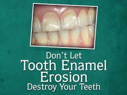 Dental Tipdon T Let Tooth Enamel Erosion Destroy Your Teeth Take Suggestions From The Dentist As Soo Dental Cosmetics Cosmetic Solution Preventive Dentistry