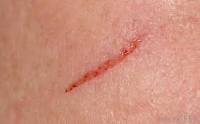 Here's how to get rid of acne scars for good! How Do I Get Rid Of Liposuction Scars With Pictures