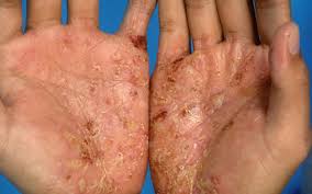 Get their location and phone number here. Eczema Treatment Singapore Dr Joycelim Dermatologist Skin Specialist