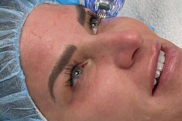 The Essential Guide to Professional RF Microneedling Devices | MDPen  Skincare