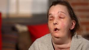 Domestic abuse survivor becomes 1st person ever to undergo second face  transplant