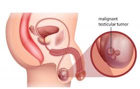 A reddish patch or irritated area, on the face, chest, shoulder, arm or leg that may crust, itch, hurt or cause no discomfort. Testicular Cancer Signs Symptoms And Treatment Options Onco Com