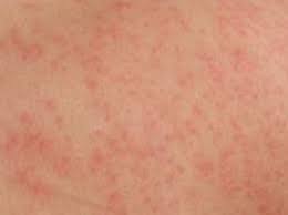 Mf can occur in people of any age, but most who get it are in their 50s or 60s. Symptoms Of Cutaneous Lymphoma Stanford Health Care