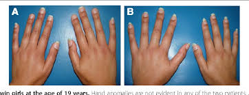 Classification of hand anomalies in poland\'s syndrome. Figure 2 From De Novo Deletion Of Chromosome 11q12 3 In Monozygotic Twins Affected By Poland Syndrome Semantic Scholar