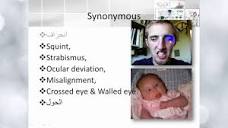Squint; definition and types - YouTube