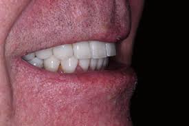 Image result for Dentition