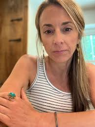 Life after transmetatarsal amputation and finding community support