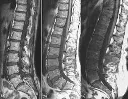 Treatment response, detection of relapse. Role Of Mri For The Diagnosis And Prognosis Of Multiple Myeloma European Journal Of Radiology